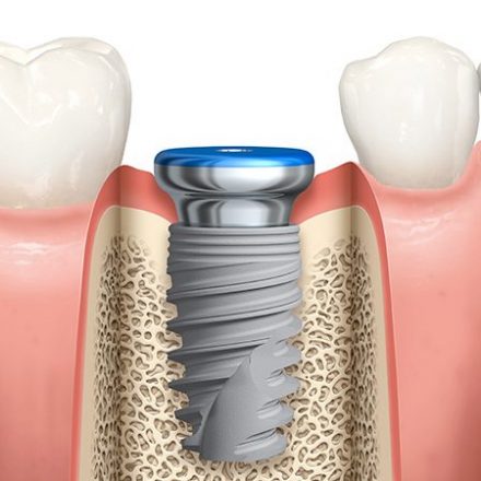 Important Questions One Should Ask Before Dental Implant