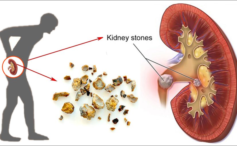 Is Kidney Stone Treatment Effective at Home?